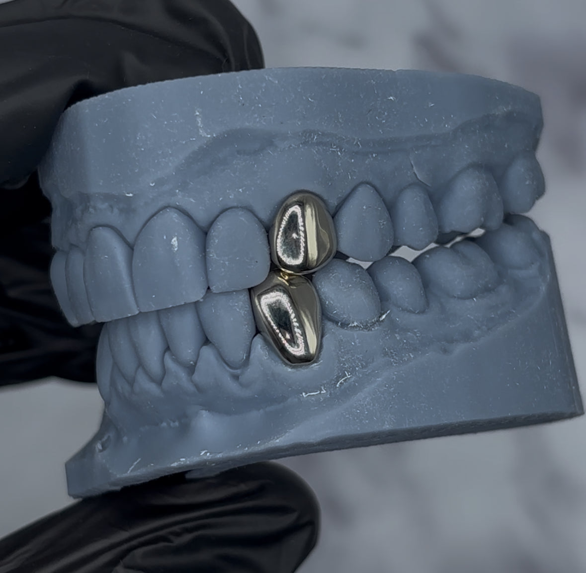 Permanent Gold Crowns