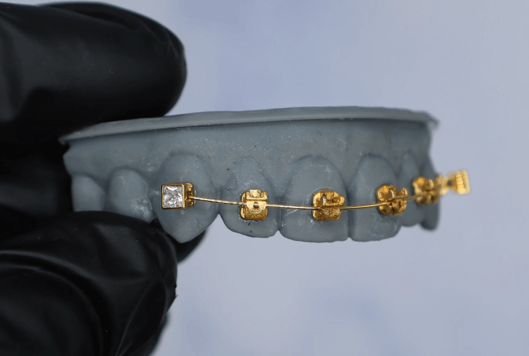 IceWire diamond braces bracket with gold and diamond detail on upper teeth 
