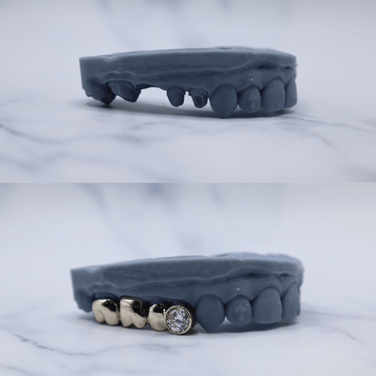 Gold Dental Bridges w Diamonds